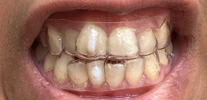 Clear orthodontic retainer used for aligner-style treatment
