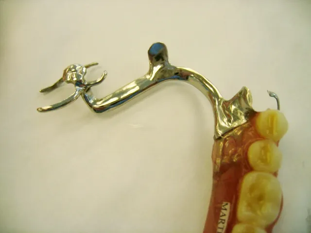Complete denture example