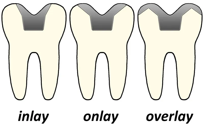 Dental inlay and onlay restorations