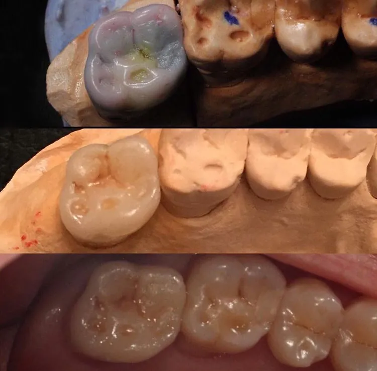 Full porcelain dental crown