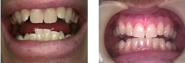 Before and after orthodontic braces treatment