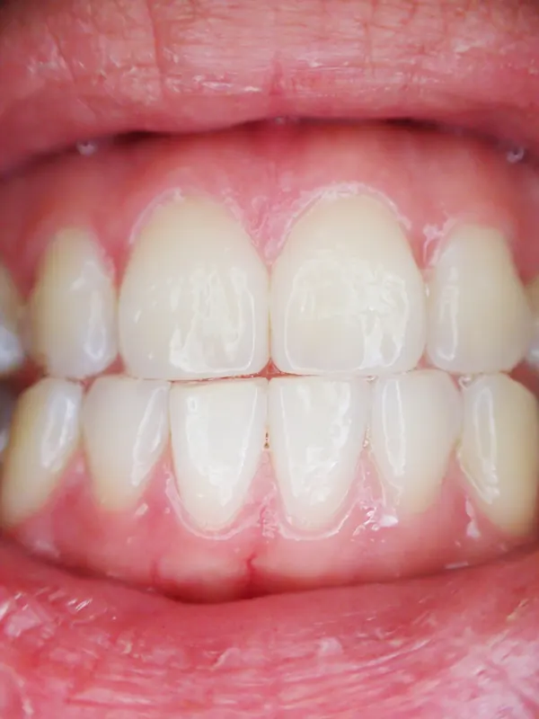 Close-up smile used for veneer aesthetic planning