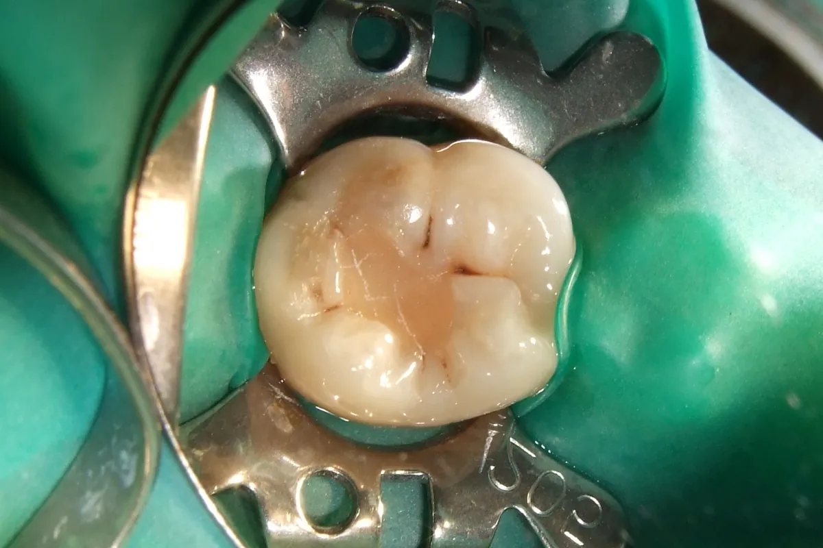 Composite resin dental filling